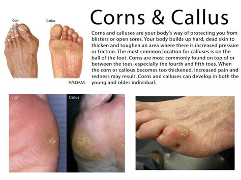 How To Remove Corns On Your Hands At Richard Weaver Blog