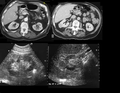 Renal Cell Carcinoma Ultrasound Kidney