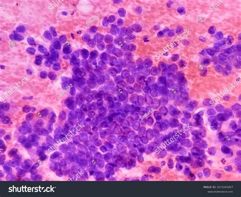 Photomicrograph Fine Needle Aspiration Fna Cytology Stock Photo