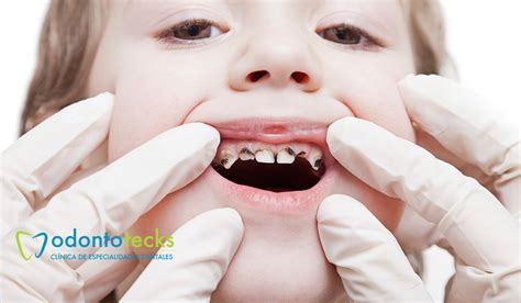 Cómo prevenir la caries en los niños Odontotecks