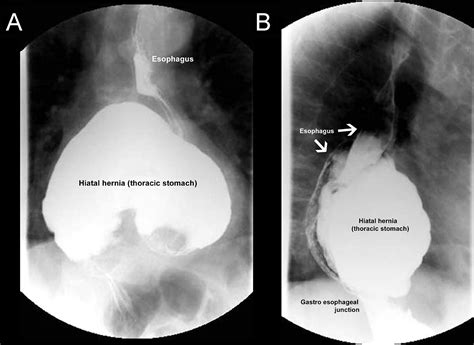 Massive Hiatal Hernia and Thoracic Stomach Illustrated by Barium