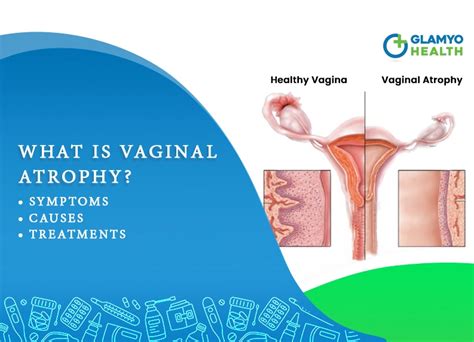 Atrophic Vaginitis Treatment