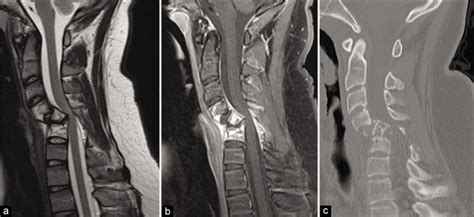 Surgical Management Of Symptomatic Vertebral Hemangiomas A Case Report