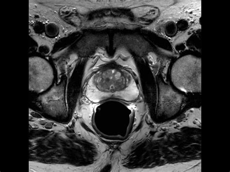 Prostate Imaging With Ds Endo Ds Torso Coil Philips Mr Body Map