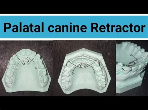 Palatal Canine Retractor Canine Retractor Easy Step Of Palatal