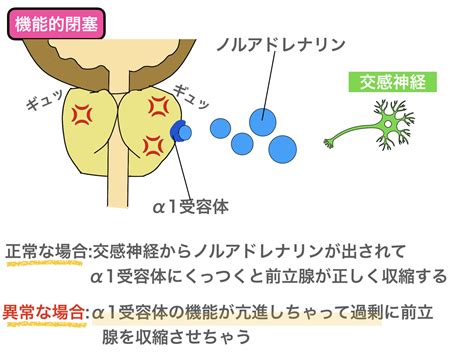 前立腺肥大症の治療は病態とは？看護師国家試験をわかりやすく解説！