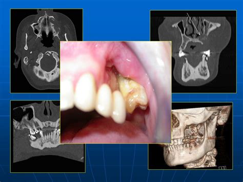 Ppt Osteonecrosis De La Mand Bula Y Bifosfonatos Semiolog A En Tc