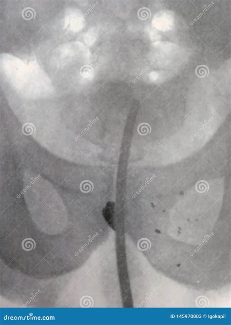 What Is A T Shot Abdomen Xray 2