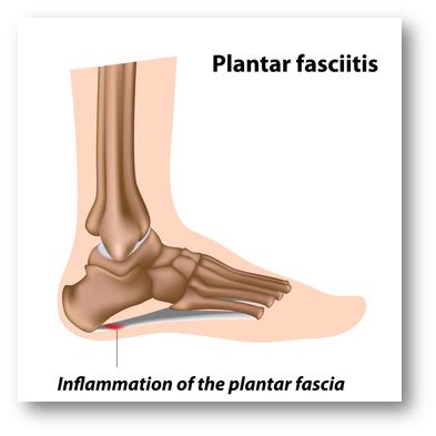 heel pain treatment   motion sarasota fl pt