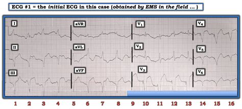 Dr Smith S Ecg Blog Acute Coronary Occlusion Seen In Paced And Non