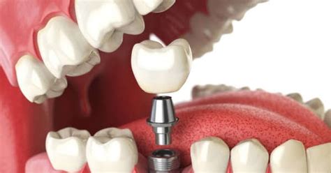 Dr Paulo Pinho How Dental Implants Sydney Can Improve The Quality Of Life