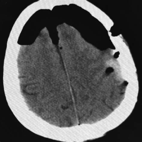 Initial CT-scan showing tension pneumocephalus. | Download Scientific Diagram