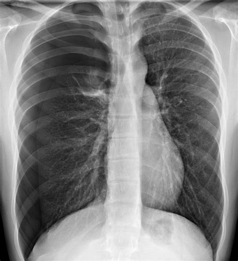 Pneumothorax (Traumatic) - Injuries; Poisoning - Merck Manuals ...