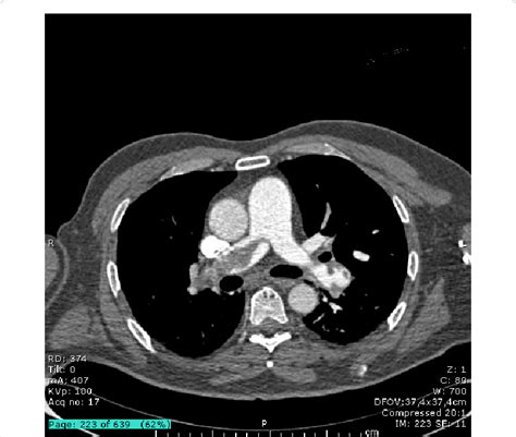 Ct Scan Short Axis Documented Massive Pulmonary Embolism With Download Scientific Diagram