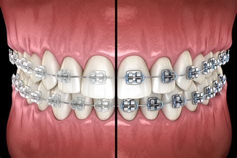 Ceramic Or Metal Braces Which Should I Choose Reddick Orthodontics