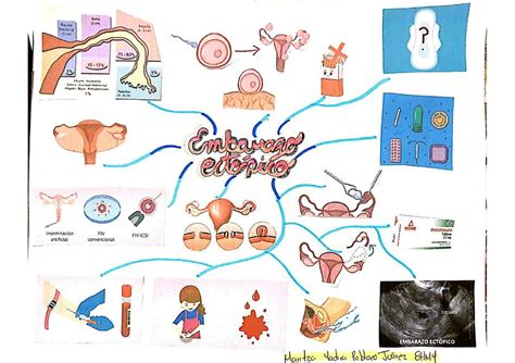 Mapa Conceptual De Embarazo Euctopico Porn Sex Picture