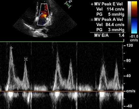 Doppler And Tissue Doppler In Left Ventricular Diastolic Dysfunction