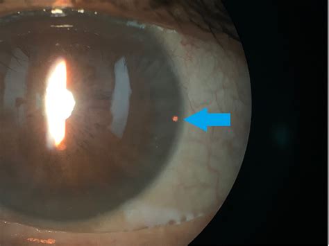 Laser Treatment For Glaucoma Types Treatment Benefits Side Effects