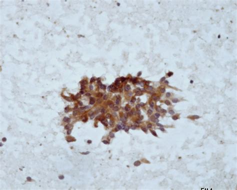 Epithelioid sarcoma - Eurocytology