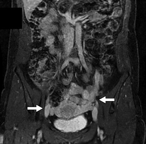 Pelvic Venous Insufficiency Imaging Diagnosis Treatment Approaches