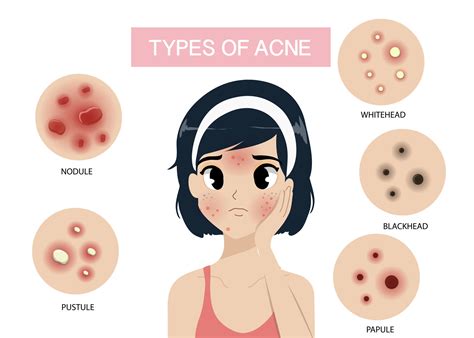 Acne Vulgaris: Causes, Types, and Specialized Treatment | Maple Clinic