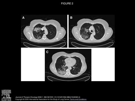 Multiple Pulmonary Nodules In An Elderly Woman Ppt Download