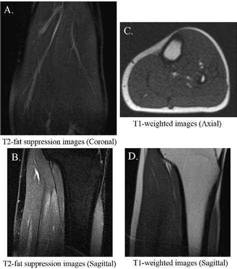 Figure 4 from A Traumatic Intermuscular Hematoma Mimicking a Soft-tissue Tumor: A Case Report ...