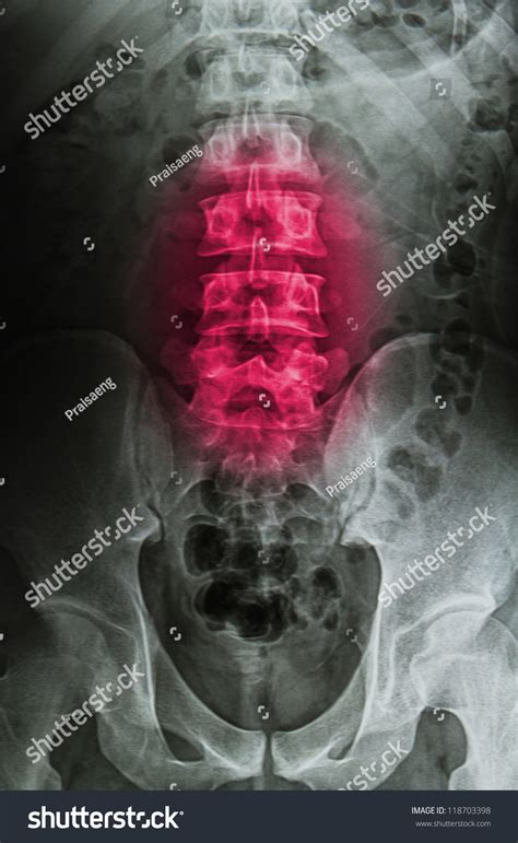 Injury Painful Back X Rays Image Spinal Stock Photo 118703398