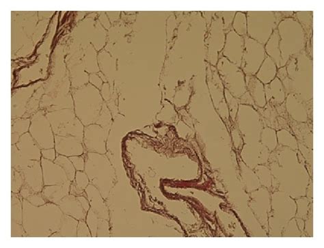 Histological Features Of Mummified Tissue From Individuals With A