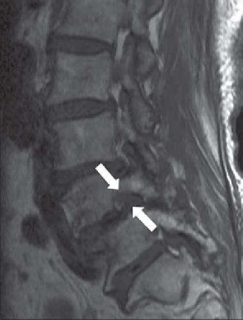 Case Of Grade 3 Foraminal Stenosis T1weighted Sagittal Image Of Download Scientific Diagram