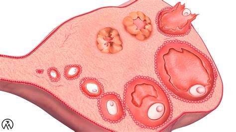 The Insulin-PCOS Connection