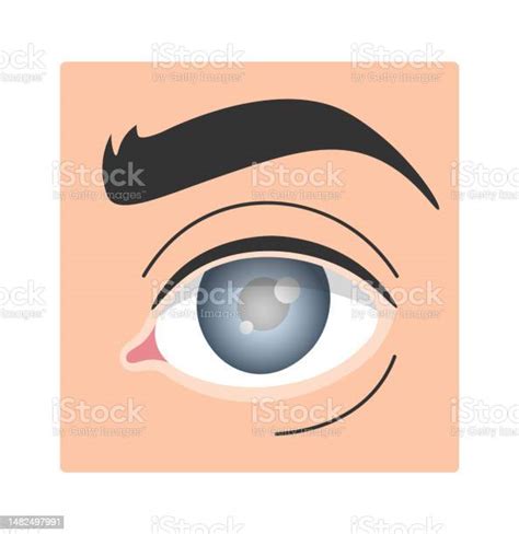 Ilustración De Glaucoma Enfermedad Del Ojo Humano Y Más Vectores Libres