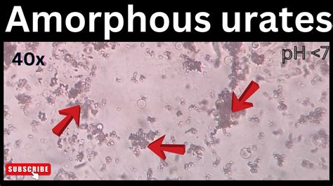 Amorphous urates in urine | @medicallabtechnologysajal6903 - YouTube