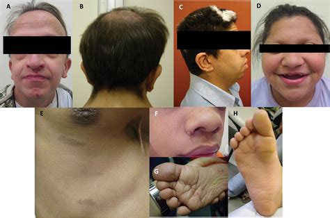 Scielo Brasil Tegumentary Manifestations Of Noonan And Noonan