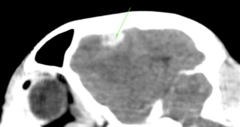 Cystite polypoïde une affection courante de la vessie chez le chien