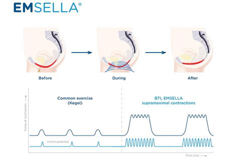 Emsella Pelvic Floor Therapy In Jacksonville Fl