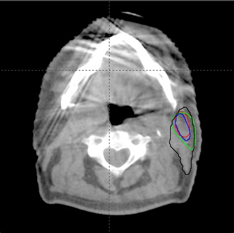 Figure From Planning Of Radiotherapy On Cone Beam Computerized