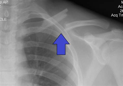 Clavicle pain facts | General center | SteadyHealth.com