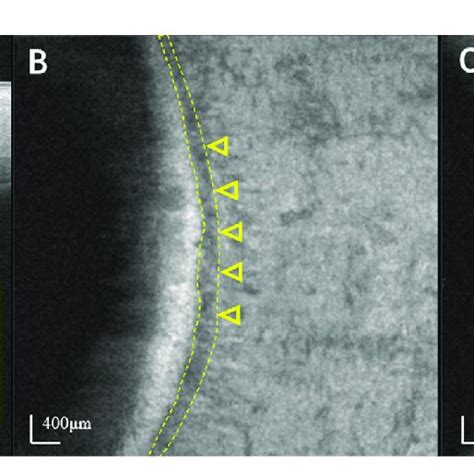 Identification Of SC Using Swept Source Optical Coherence Tomography