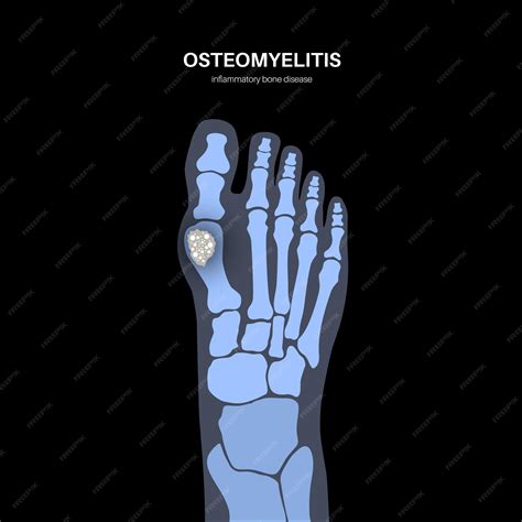 Premium Vector | Osteomyelitis disease Infected feet bones pain and