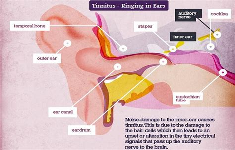 Tinnitus Remedies