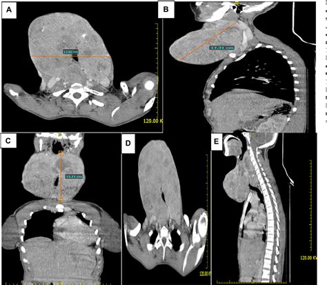 Figure 2 From A Giant Toxic Multinodular Goiter Extending Into The Retropharyngeal Space A Case