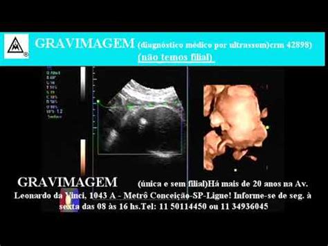 Gravimagem Ultrassom Morfol Gico Em Gravidez Semanas Mp Youtube