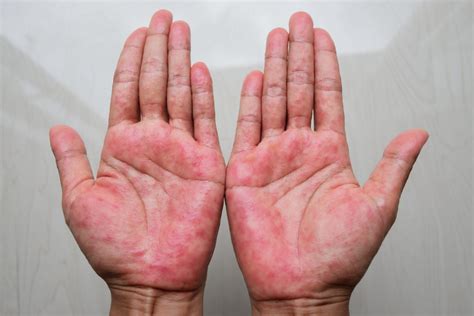 Atopic Dermatitis Eczema