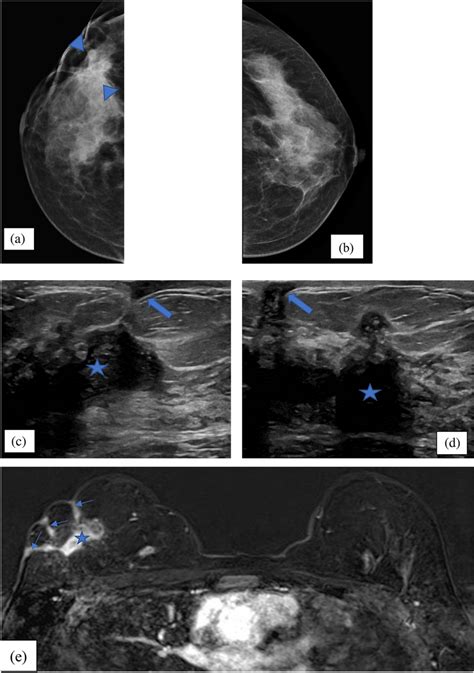 Radiological Findings In A Patient With Granulomatous Mastitis A B