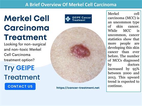 A Brief Overview Of Merkel Cell Carcinoma by GEIPE Cancer Treatment - Issuu