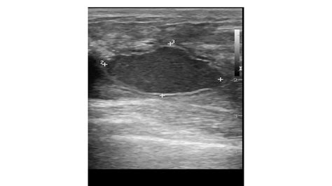 Breast abscess ultrasound - wikidoc