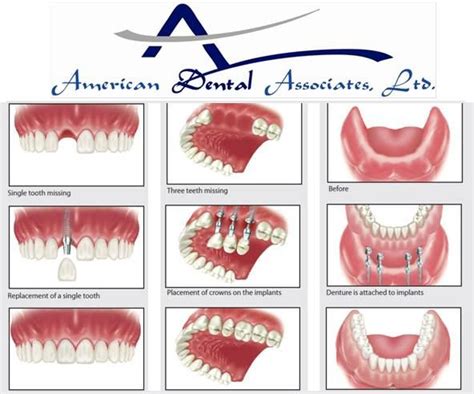 Know All About The Types Of Dental Implants Including Single Two