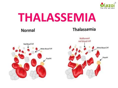 Ppt Thalessemia Overview Symptoms Complications Risk Factor Causes Daignosis And