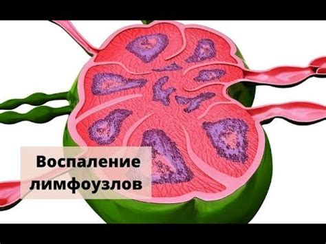 Воспаление лимфоузлов (лимфаденит) – симптомы, причины, осложнения и ...